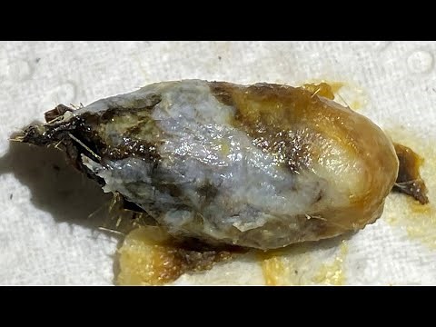 1,595 - Huge Cocoon Ear Wax Plug Extraction