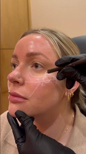 Facial Mapping for Cheek Filler #cheekfiller #cheekfillers #fillers #cosmeticnurse
