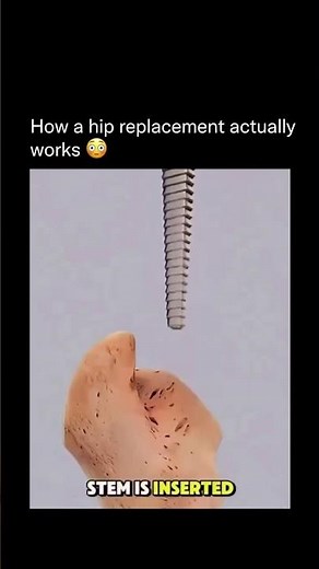 A hip replacement might sound intense but it's a precise,step bystep procedure designed to restore