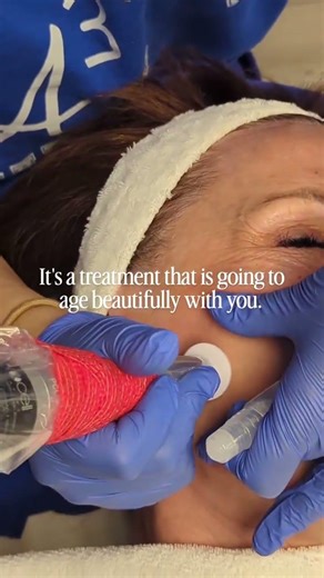 If you’re looking for a natural alternative to injectables, Procell Microchanneling is the answer 🧬