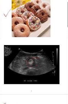 \t“Target Sign 🎯 = Intussusception! Don’t Miss This 🚨”