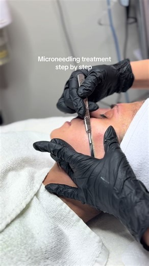 Microneedling Treatment: Step-By-Step Walkthrough