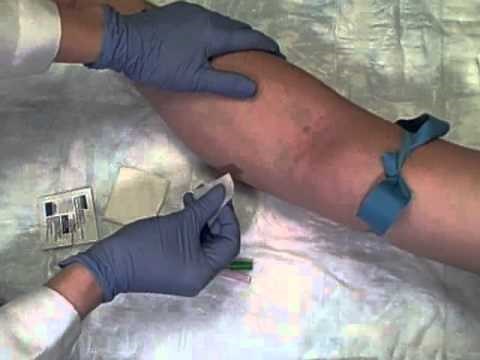 Phlebotomy on Live Patient Straight Needle