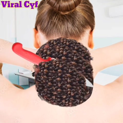 #satisfying #america #Treatment #viral #training #asmr #Remove #usareels #neck | Viral Cyf