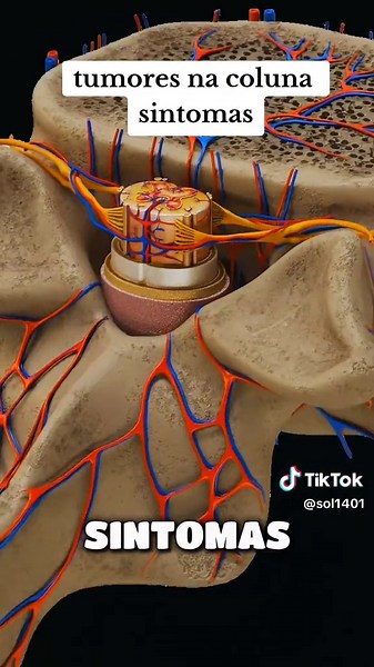 tumores na coluna sintomas #sintomas #tumor