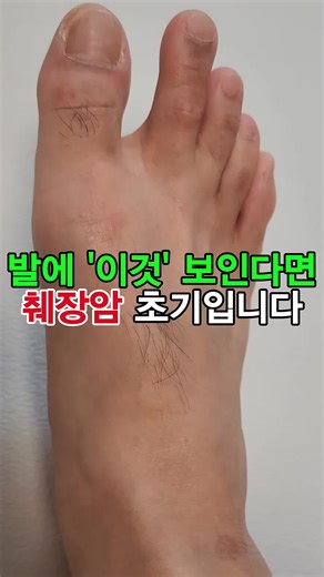 췌장암 초기 증상 알아보기