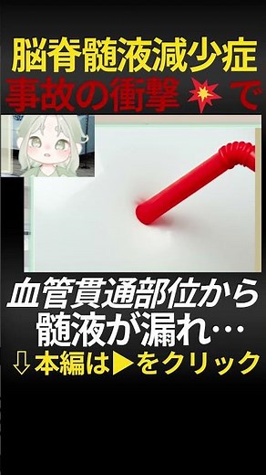 脳脊髄液減少症 原因は椎骨動脈貫通部位からの漏れかもしれません