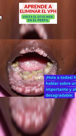 Papiloma en la boca: Todo sobre las verrugas bucales