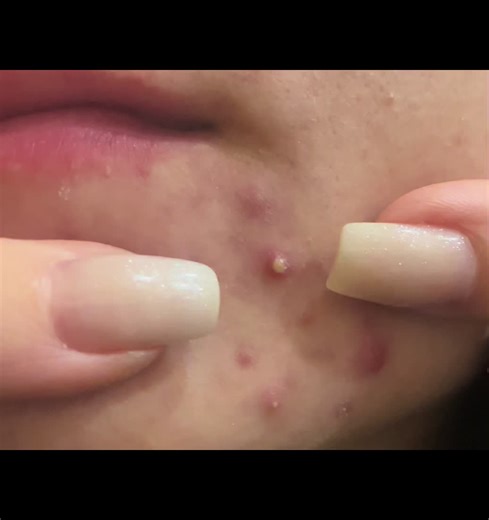 Biba Boba 2 #pimples #blackpops #PimplesHomeMade #acne #прыщи | pimple popper