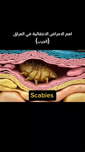 Medical information on Instagram‎: "يُعد الجرب (Scabies) مرضًا جلديًا معديًا واسع الانتشار عالميًا، تسببه عثّة تُعرف باسم Sarcoptes scabiei var. hominis. تخترق هذه العثة الطبقات السطحية من الجلد لتضع بيضها مسببةً حكة شديدة وطفحًا جلديًا مميزًا. ينتشر المرض بشكل خاص في البيئات المكتظة مثل المدارس، السجون، ودور الرعاية. وتكمن أهميته الصحية في سرعة انتشاره وصعوبة السيطرة عليه في البيئات المغلقة، خصوصًا عندما يكون التشخيص متأخرًا. ⸻ طرق الانتشار ينتقل الجرب أساسًا عن طريق الاتصال الجلدي المباشر والم