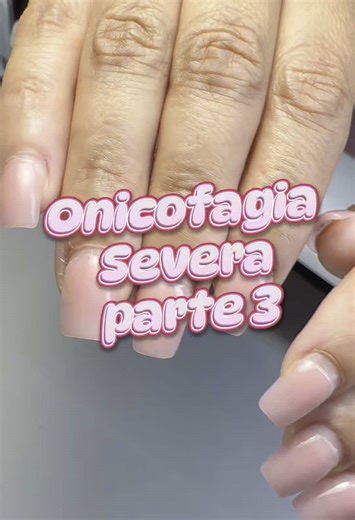 Uñas con Onicofagia Severa: Cuidados y Soluciones