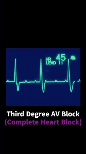 Complete Heart Block #cardiachealth #ecg #ekg #ecginterpretation #ecgtechnician #nursingschool