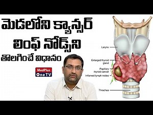 Neck Lymph Node Removal in Cancer Treatment | Dr.Avinash ‪@MedPlusONETV‬