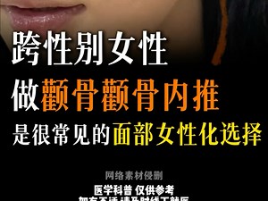 ts男变女相，面部女性化ffs做颧骨内推很常见✅