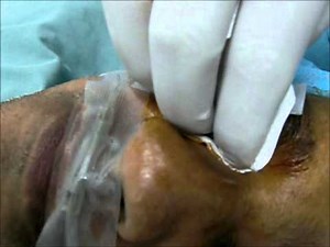 Peribulbar anesthesia using the Single-injection percutaneous technique by Dr. Ashraf Ghali 2012