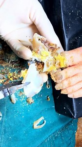 Ingrown Toenail Removal Treatment | Step-by-Step Cleaning Process | CTH A1