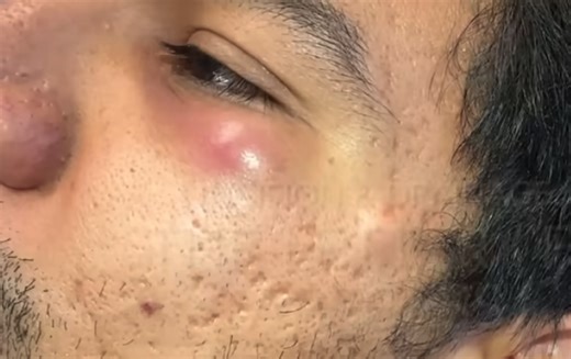 Under Eye Abscess Incision and Drainage