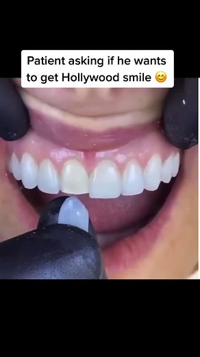 Veneers Procedure: Transforming Your Smile with Veneers Check