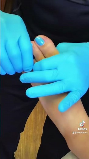 Dislocated toe fracture, toe was relocated in the office