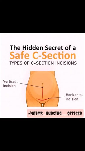 Nursing & Medical Profession 🔵 on Instagram: "The Hidden Secret of a Safe C-Section: Understanding Incision Types 🔪🤰 When it comes to a C-section, the type of incision made is a key part of your safety and recovery. Knowing the difference can help you feel more informed and empowered about your birth experience. Let's break it down simply: Horizontal Incision (Most Common) Also called a "bikini-line incision," this cut is made low across the abdomen, just above the pubic hairline. It’s prefer
