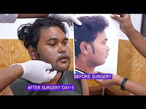 Genioplasty with Chin and Cheek Reduction Surgery