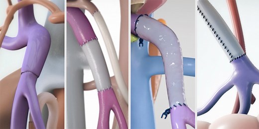 pNET with vascular reconstruction - TVASurg - The Toronto Video Atlas of Surgery