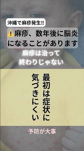 ⚠️麻疹、数年後に脳炎になることがあります#麻疹 #はしか #SSPE #亜急性硬化性全脳炎 #合併症 #予防接種 #ワクチン #子どもの病気 #小児科 #育児不安 #夜間救急 #ママ向け #子育て