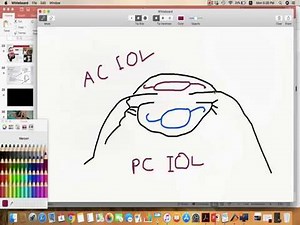 Cataract extraction surgery