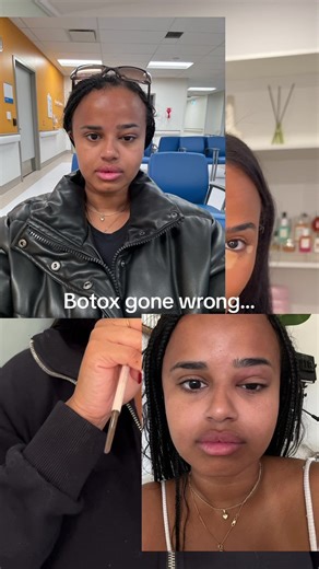 Any health professionals out there with any advice on my Botox gone wrong situation? I experienced ptosis for 3 months after receiving Botox and it was a pretty bad case. I’ve had Botox done in the past and it never happened prior. Is it safe to get it again 😖 #nurseinjector #botox #botoxgonewrong #fyp