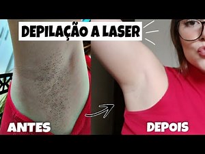 DEPILAÇÃO A LASER FUNCIONA MESMO? MINHA EXPERIÊNCIA 10 SESSÕES DEPOIS - ESPAÇO LASER