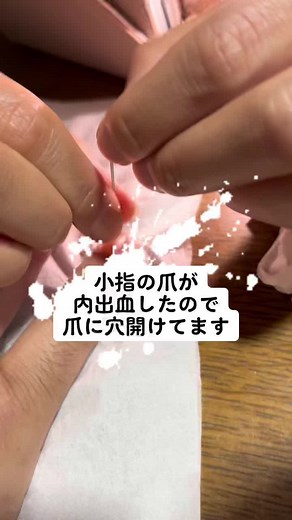 小指の爪の内出血を自分で血を抜く方法