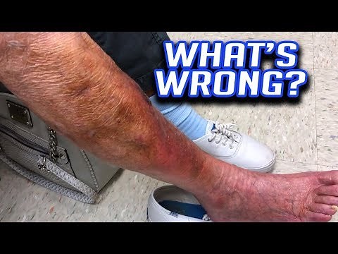 Ms. Blues' Thrombophlebitis