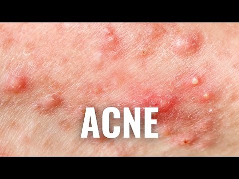 If You’re Prone to ACNE, Avoid These 8 Things for Clearer, Healthier Skin