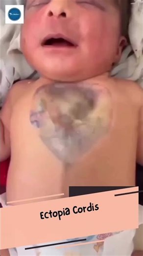 Dr Medica Clinical Cases || Ectopia Cordis || Paediatrics || Clinical Medicine ||