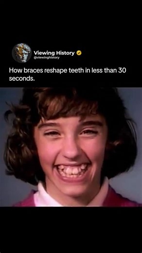 @viewinghistory on Instagram: "This timelapse shows the incredible process of how braces slowly shift teeth into alignment, condensed into less than 30 seconds. What normally takes months or years happens here in a smooth transformation — teeth rotating, moving, and settling into their proper places as wires and brackets apply gentle, constant pressure. It’s a fascinating look at how orthodontics works beneath the surface, reshaping a smile millimeter by millimeter until everything lines up perf