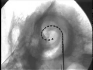 2014 Cochlear Implant electrode insertion