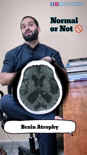 Anis Qureshi 🍁 on Instagram: "Brain Atrophy on CT ≠ Always Disease 🧠❗ Know when it’s NORMAL and when to worry. Brain atrophy is a common CT scan finding, especially in elderly patients, and it is often physiological (normal) rather than pathological. In this reel, I’ve explained: • Why brain atrophy is frequently mentioned in CT reports • Age-related (physiological) brain atrophy • How to differentiate normal vs abnormal atrophy on CT • Why clinical correlation is essential before labeling it 