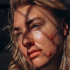 2.2M views · 375 reactions | Meet the woman who did not allow her severe acne stop her from finding true love ❤️ | Shake My Beauty | Facebook