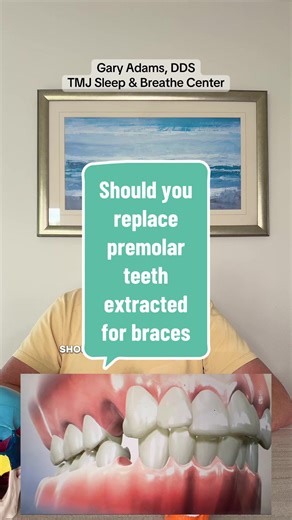 Replacing Premolar Teeth for Braces: Expert Insights
