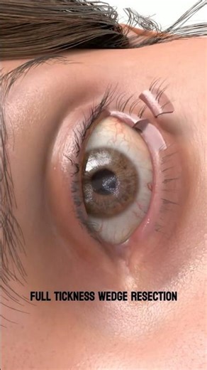 Wedge Resection 💫 Animation by ‪@plastic.touch.‬ Unauthorized use or reposting of this animation➡️