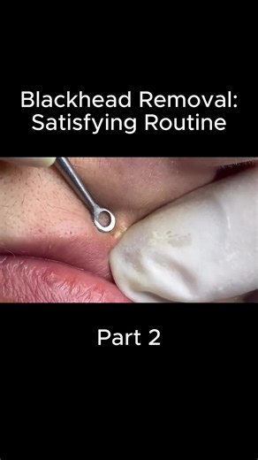 Effective Solutions for Acne and Blackheads