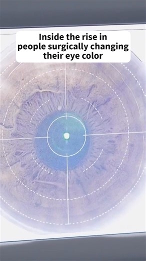 As surgery to permanently change eye color grows in popularity, the American Academy of Ophthalmology is warning of potential risks, including cloudy vision or loss of vision. Learn what you need to know if you're considering the cosmetic procedure. | Today Show