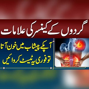 21K views · 231 reactions | Kidney Cancer Causes and Treatment- Kidney Cancer Ka Kya ilaaj Hai - Kidney Cancer Ke Lakshan - Kidney Cancer Treatment - Kidney Pain #KidneyCancer #CancerAwareness #KidneyHealth #KidneyCancerTreatment #KidneyCancerSymptoms | Sehat Mand - Health & Lifestyle | Facebook