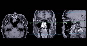 High-resolution Mri Scan Paranasal Sinuses Medical Stock Footage Video (100% Royalty-free) 3622844393 | Shutterstock