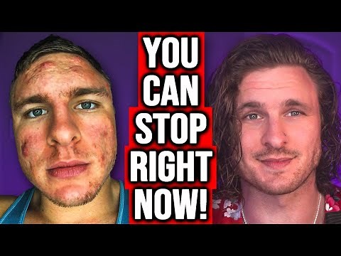 THE FASTEST WAY TO STOP PICKING AT YOUR ACNE