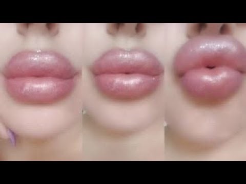 bimbo russian lip filler