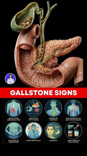 8 Gallbladder Stone Symptoms You Should Never Ignore