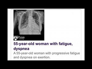 Pulmonary veno-occlusive disease (PVOD)