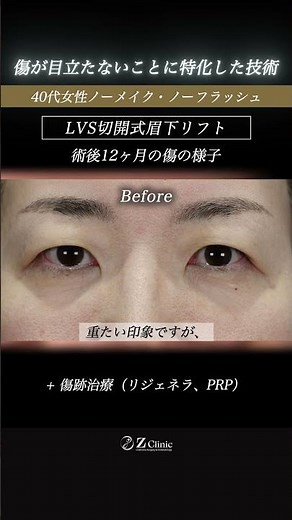 [Resolving the "umbrella-like" appearance of the upper eyelid | 12 months post-eyebrow lift (brow...
