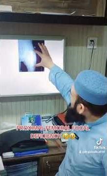 Proximal Femoral Focal Deficiency#duet#viralvideo